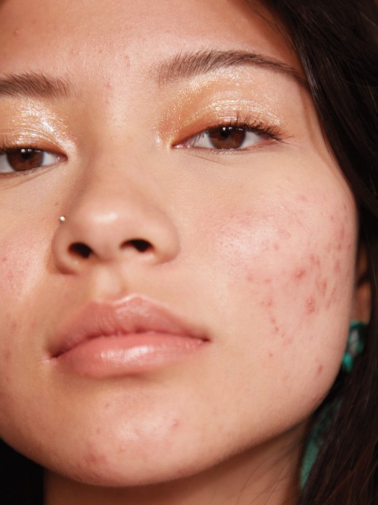 oily / acne prone
