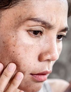 dark spots/ pigmentation